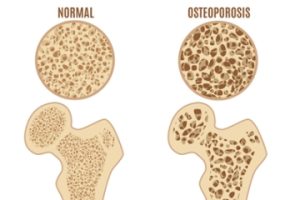 Read more about the article HATI-HATI OSTEOPOROSIS DAPAT TERJADI DI USIA MUDA